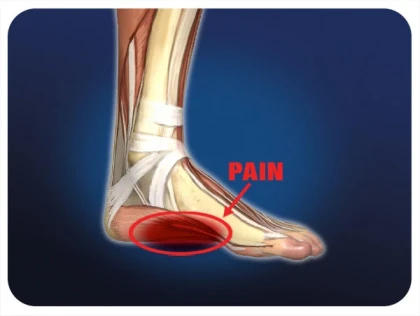 Plantar Fasciitis