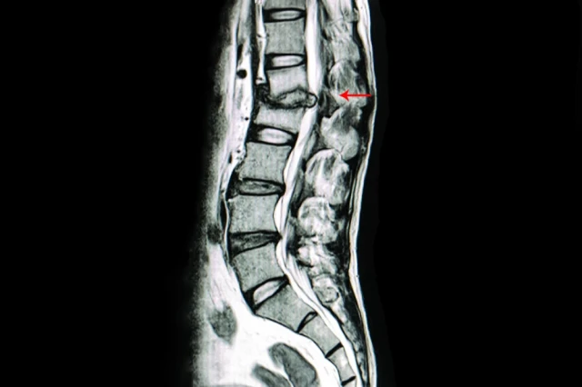 Scan of a spine | Degenerative Disc Disease