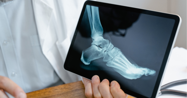 What You Need to Know About Bone Density and Osteoporosis