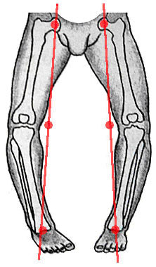 bowleg_orthocarolina.jpg