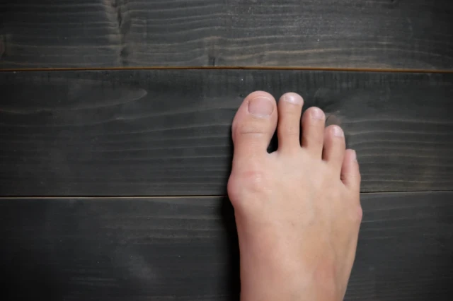 bunion on right foot
