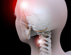 Cervicogenic Headaches Orthopedic Blog Orthocarolina