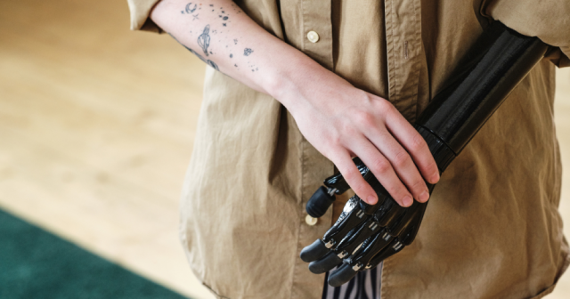 Current Concepts in Upper-Extremity Amputation