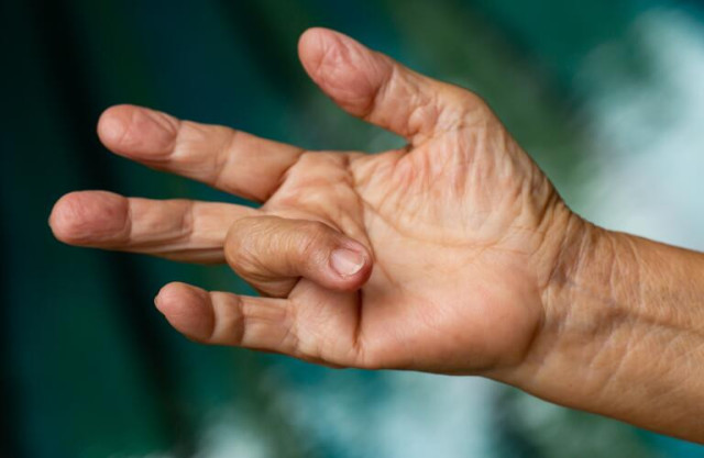 Five Symptoms That Point to Trigger Finger