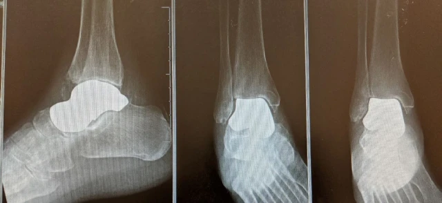 Talus Foot and Ankle X-ray Image