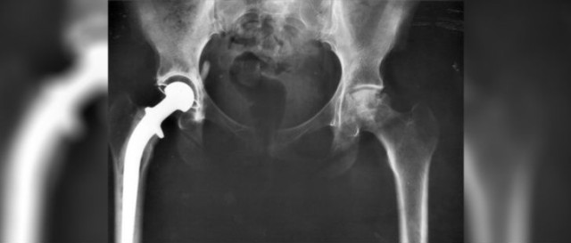 Hip X-ray from OrthoCarolina