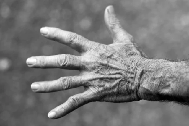 Basilar Joint (thumb) Arthritis