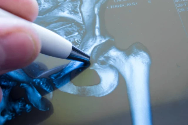 Periprosthetic joint infection.
