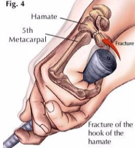 Fracture of the hook of hamate