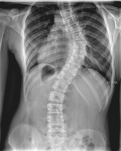 X-ray of scoliosis patient