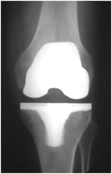 Joint Replacement