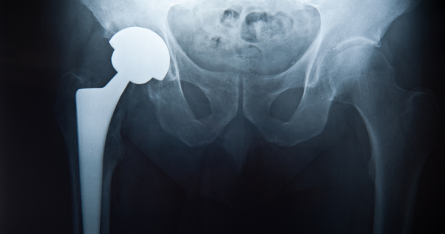 X ray of hip joint replacement