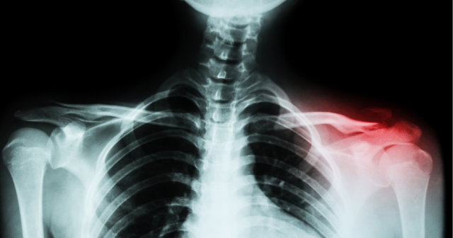 Understanding Subacromial Decompression & Distal Clavicle Resection
