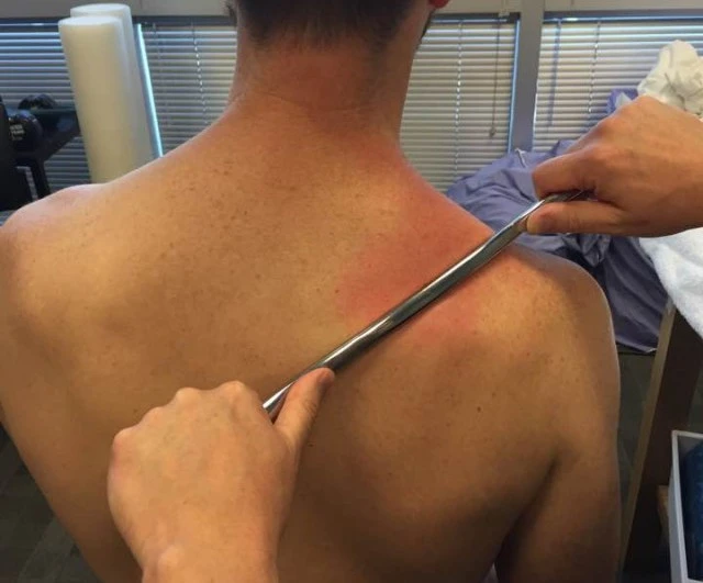 Graston Technique Scrape The Pain Away Orthopedic Blog OrthoCarolina