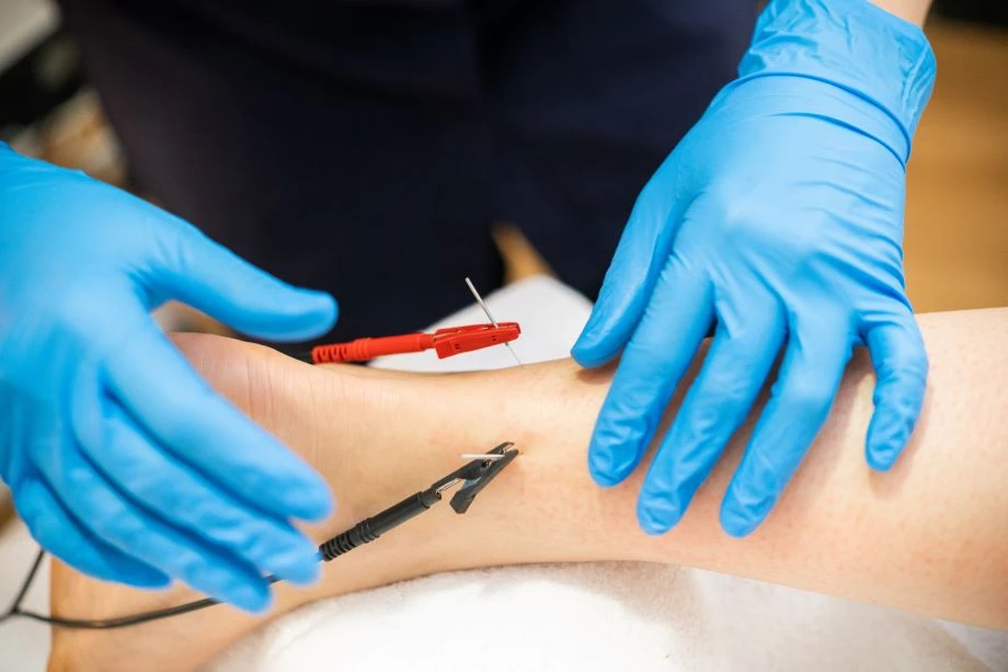 What You Need to Know About Dry Needling with Electrical Stimulation