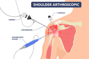 Shoulder arthroscopic diagram showing camera, cannula, arthroscope, and arthroscopic shaver used in minimally invasive surgery.