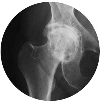 Hip X-ray