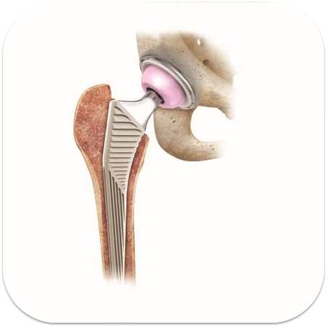 Diagram of Hip Replacement
