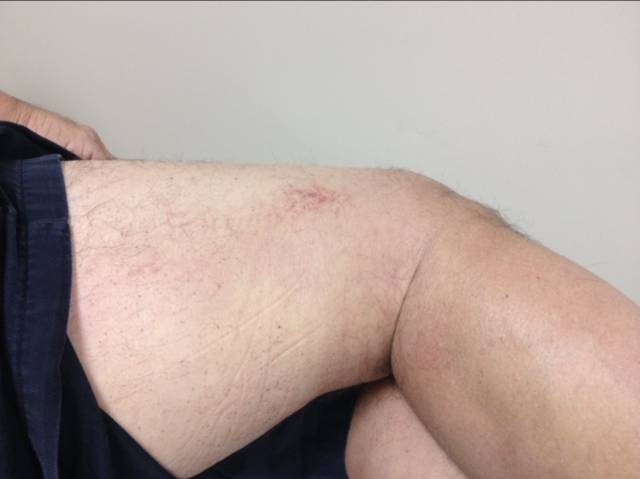 Bruise - Post Tape Bruise - Post Tape
