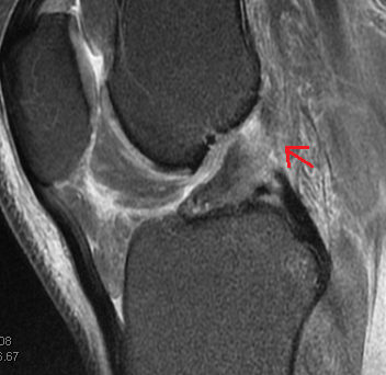 MRI of a sagittal (side view) image of the knee