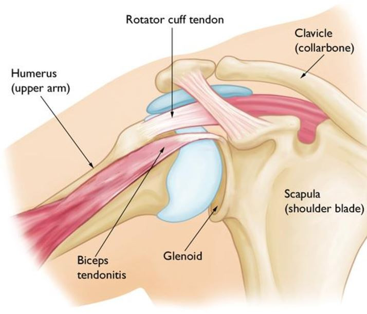Bicep Tendinitis Diagram | courtesy of the American Academy of Orthopedic Surgeons Bicep Tendinitis Diagram | courtesy of the American Academy of Orthopedic Surgeons