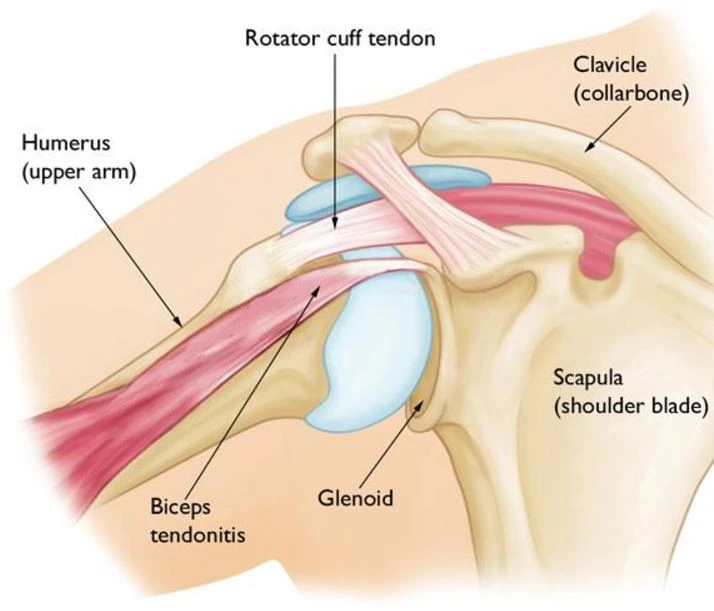 Bicep Tendinitis Diagram | courtesy of the American Academy of Orthopedic Surgeons