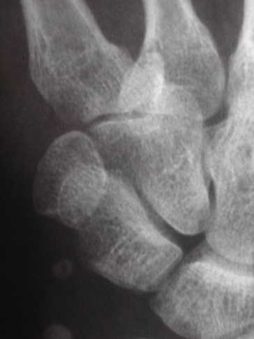 X-ray X-ray