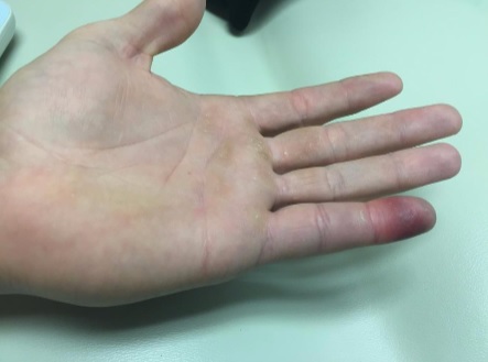 Injured Hand