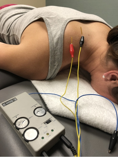 Physical therapist Beverly Knight uses dry needling techniques with electrical stimulation on the upper trapezius and levator muscles that are often involved with neck pain.