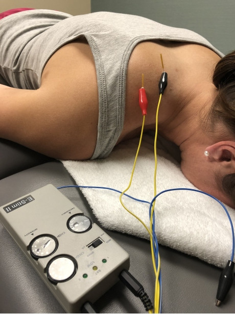 Physical therapist Beverly Knight uses dry needling techniques with electrical stimulation on the upper trapezius and levator muscles that are often involved with neck pain. Physical therapist Beverly Knight uses dry needling techniques with electrical stimulation on the upper trapezius and levator muscles that are often involved with neck pain.
