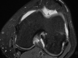 A matching MRI from the same patient's knee.