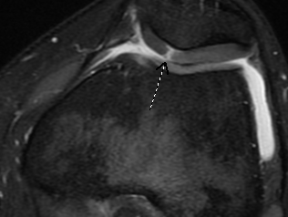 An MRI from the same patient's knee. The arrow points to the area on the patella (kneecap) where healthy, intact cartilage is missing. An MRI from the same patient's knee. The arrow points to the area on the patella (kneecap) where healthy, intact cartilage is missing.
