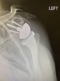 X-ray that shows a reverse total shoulder arthroplasty.