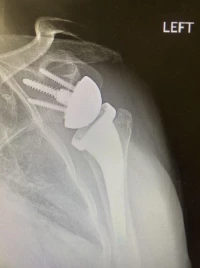 X-ray that shows a reverse total shoulder arthroplasty. X-ray that shows a reverse total shoulder arthroplasty.