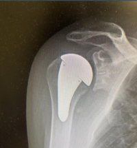 Total Shoulder Arthroplasty