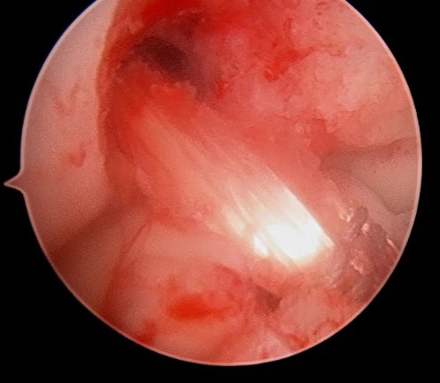 Arthroscopic image of reconstructed ACL using the tendon from the front of the knee Arthroscopic image of reconstructed ACL using the tendon from the front of the knee