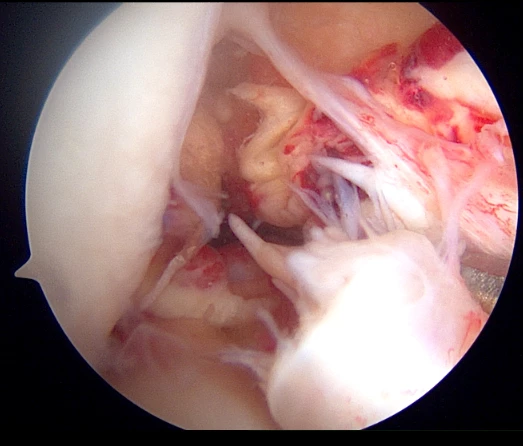 Arthroscopic image of torn ACL fibers