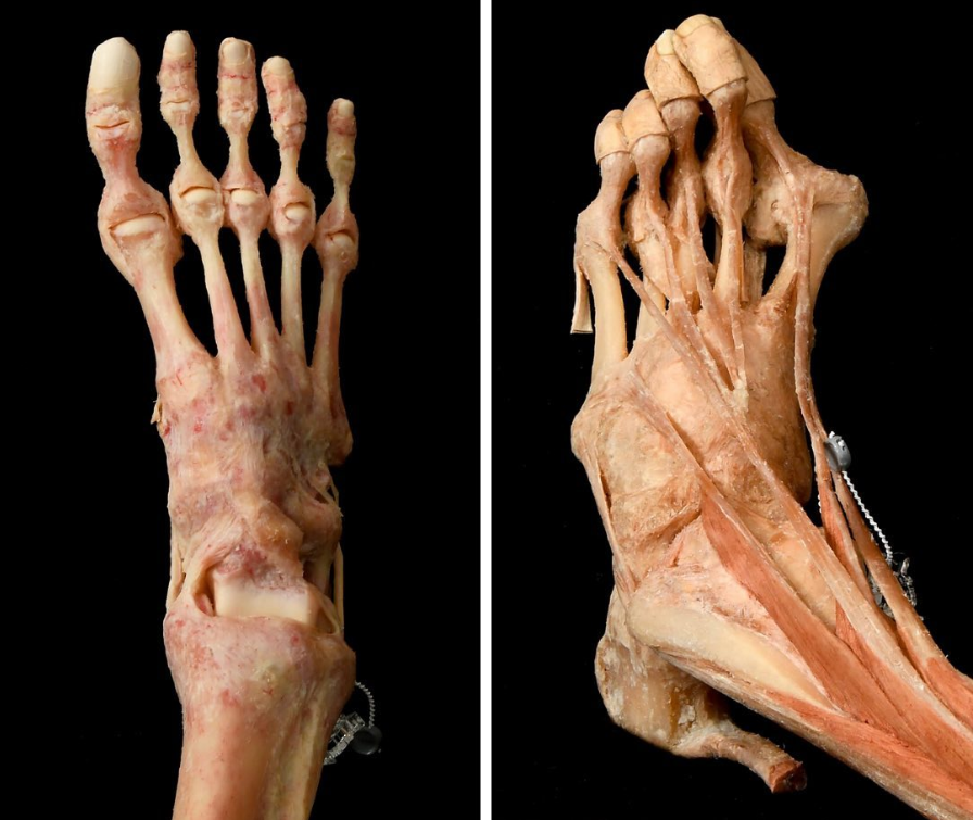 A healthy foot versus a foot with a severe bunion.