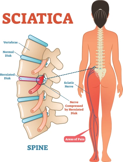 Sciatica Nerve Pain:  Nerve pain relief, Nerve pain, Sciatic nerve pain