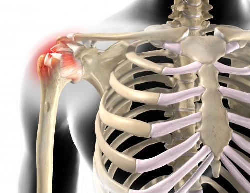 shoulder impingement damaged rotator cuff