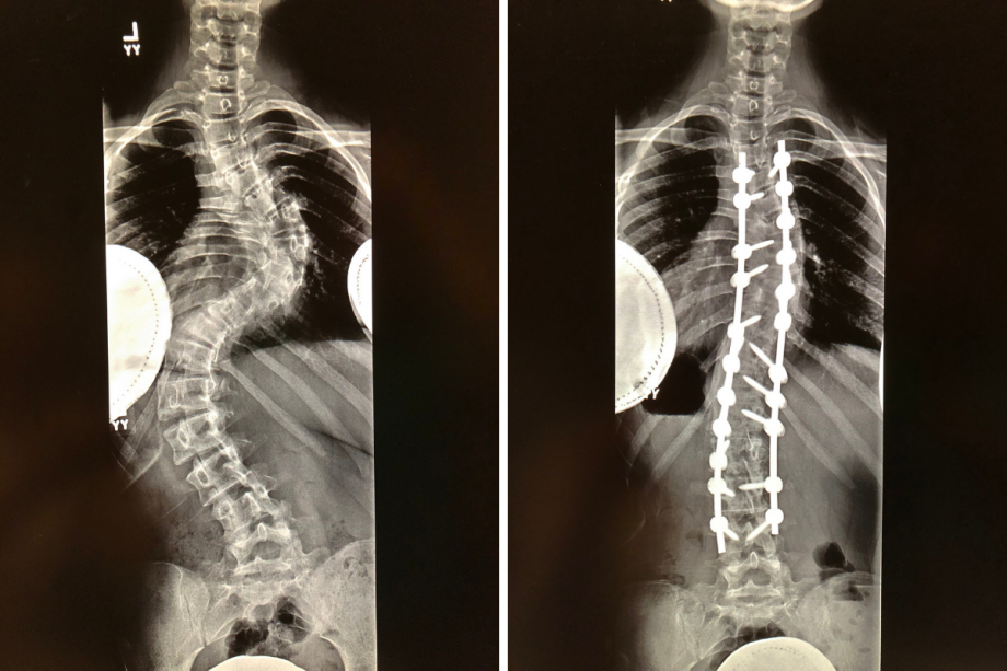 Though only about 5% of Dr. Paloski's patients require surgery, that surgery is life-changing for the patient and family. Though only about 5% of Dr. Paloski's patients require surgery, that surgery is life-changing for the patient and family.