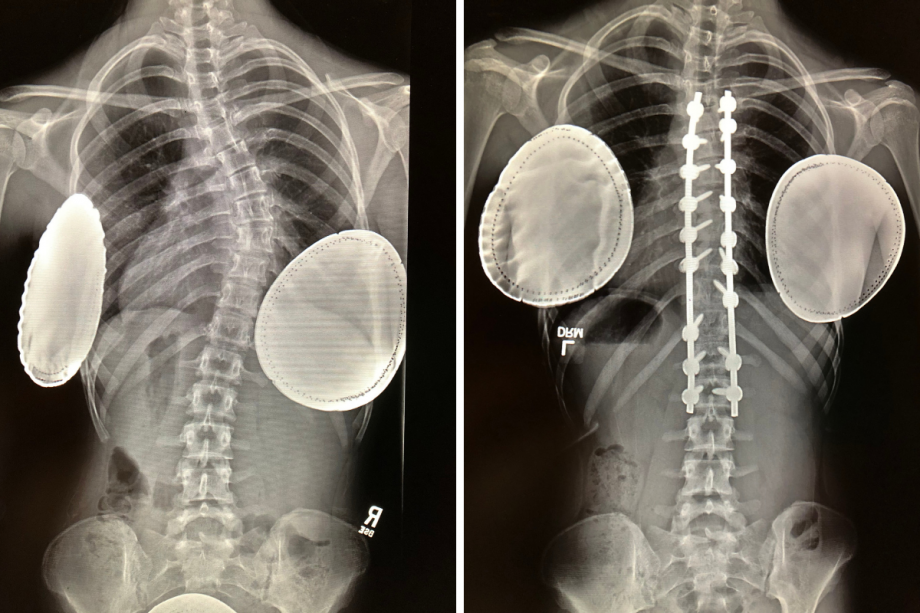 The curved spine of one of Dr. Paloski's patients on the left and the spine after surgery on the right.