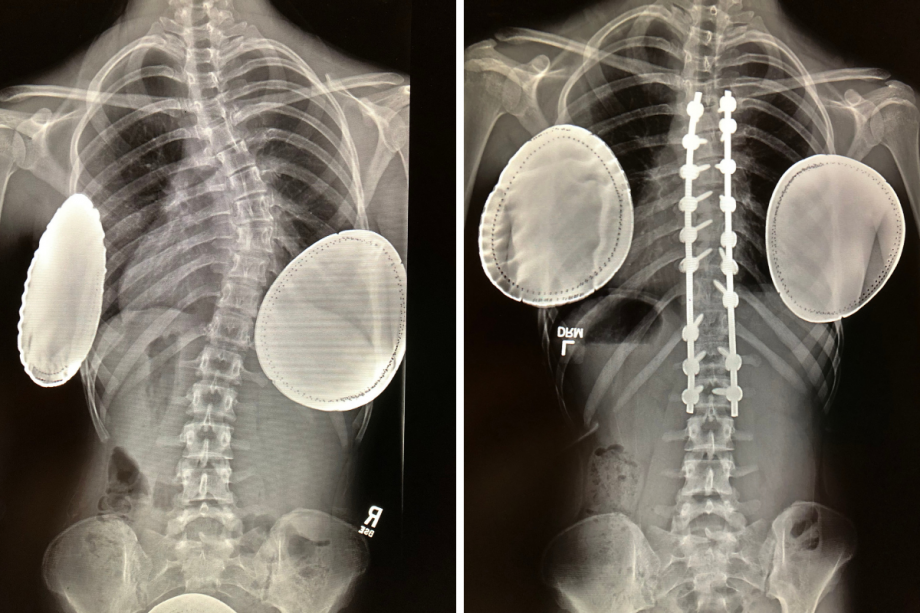 The curved spine of one of Dr. Paloski's patients on the left and the spine after surgery on the right. The curved spine of one of Dr. Paloski's patients on the left and the spine after surgery on the right.