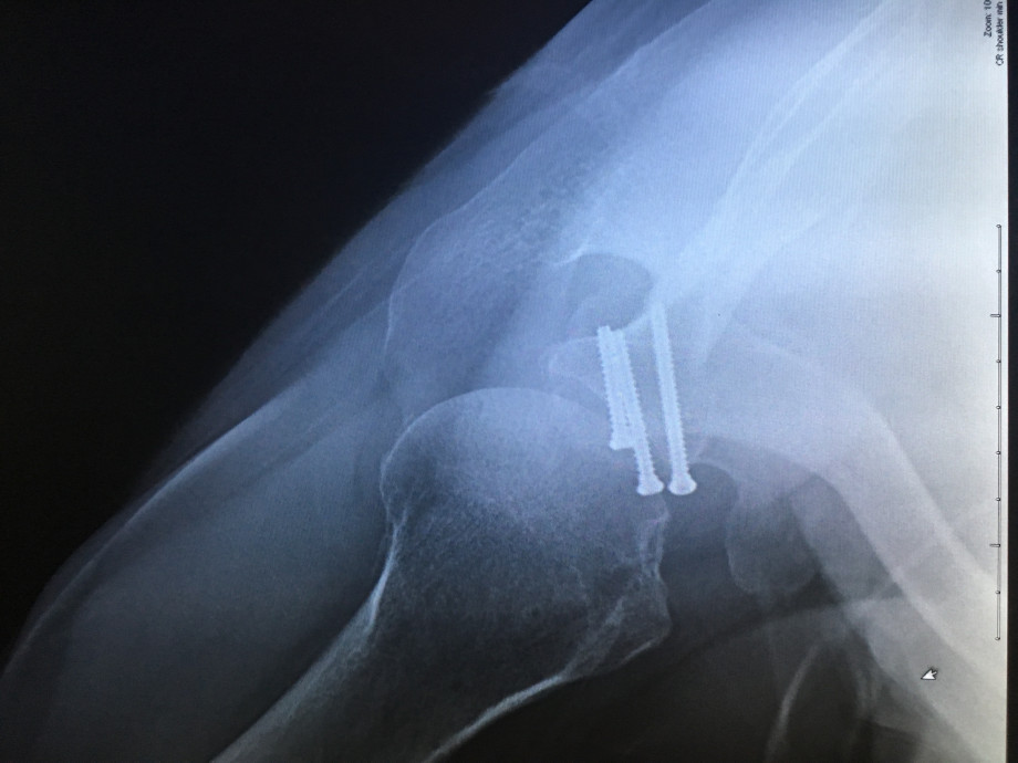 A look at the repair to Glenn's shoulder by Dr. Patrick Connor. A look at the repair to Glenn's shoulder by Dr. Patrick Connor.
