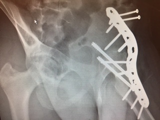 Hip Fusion Hip Fusion