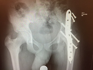 Hip Fusion Hip Fusion