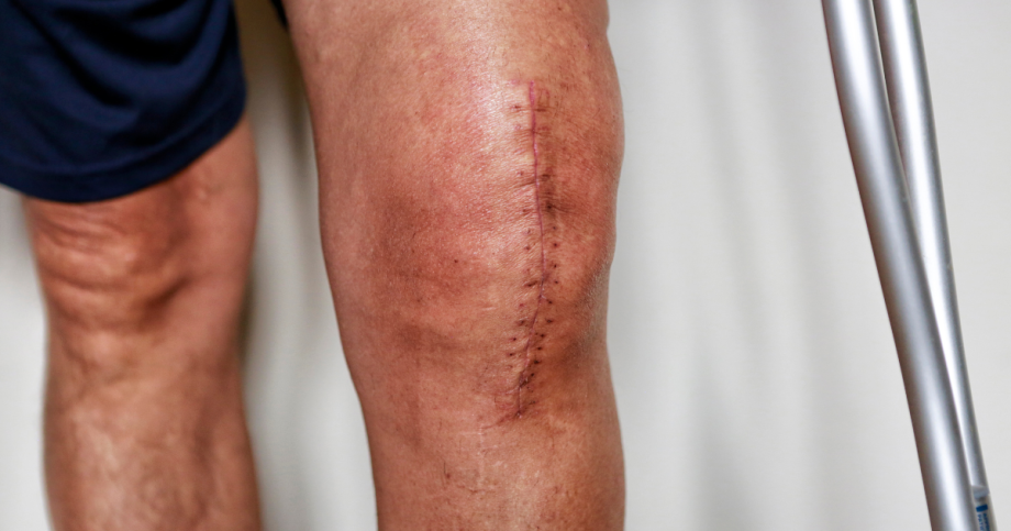 patient with knee replacement surgery scar